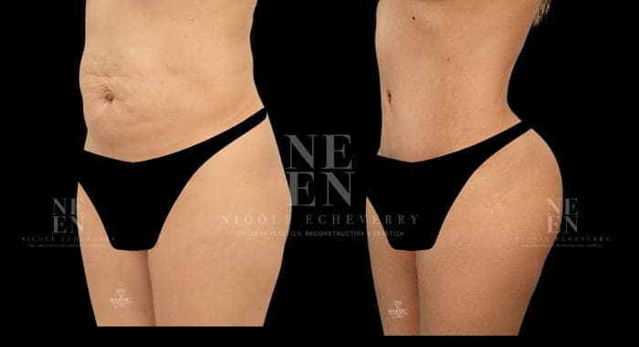 Waist and abdomen before and after — before left, after right
