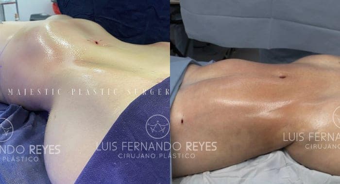 Waist and abdomen before and after — before left, after right
