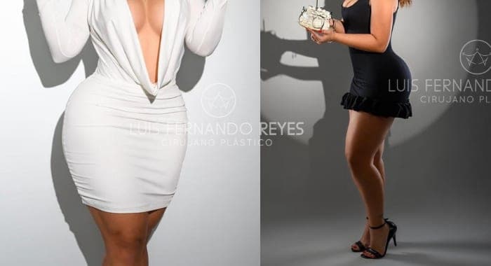 Silhouette after body contouring with Dr. Luis Fernando Reyes