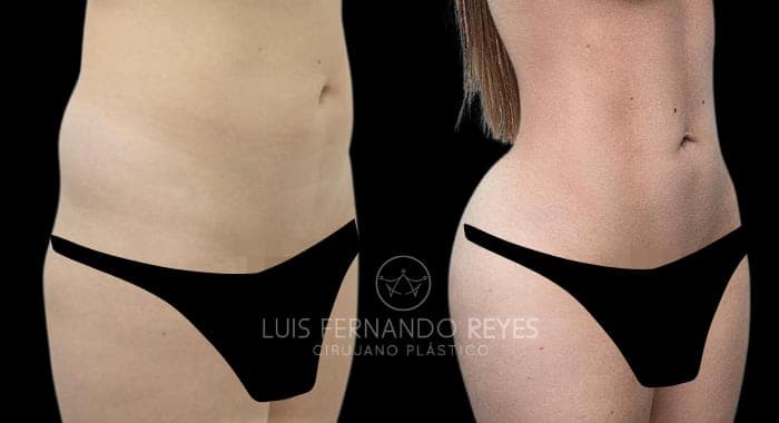 Waist and abdomen before and after — before left, after right