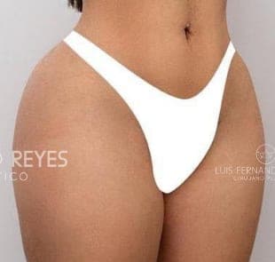 The same patient after, showing a narrower waist and a smoother waist-to-hip transition
