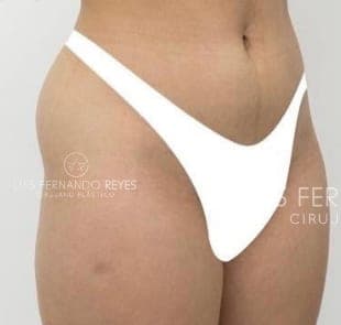 A patient's waist, abdomen and hip before body contouring with Dr. Luis Fernando Reyes