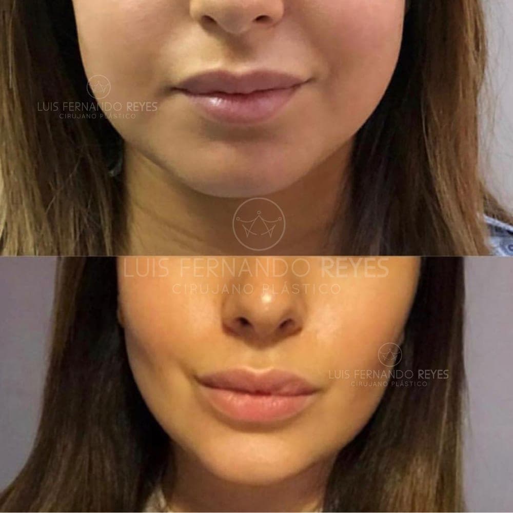 Buccal fat removal before and after — before above, after below