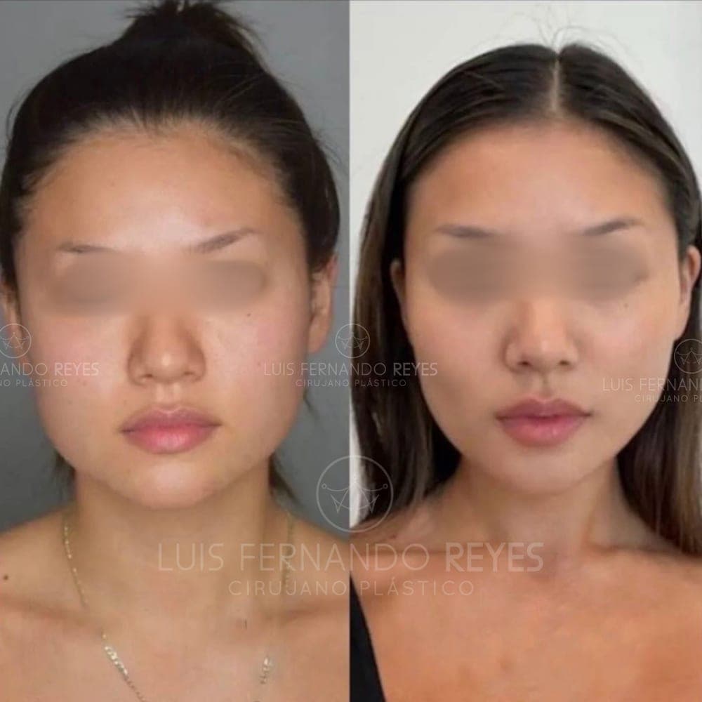 Buccal fat removal before and after — before left, after right