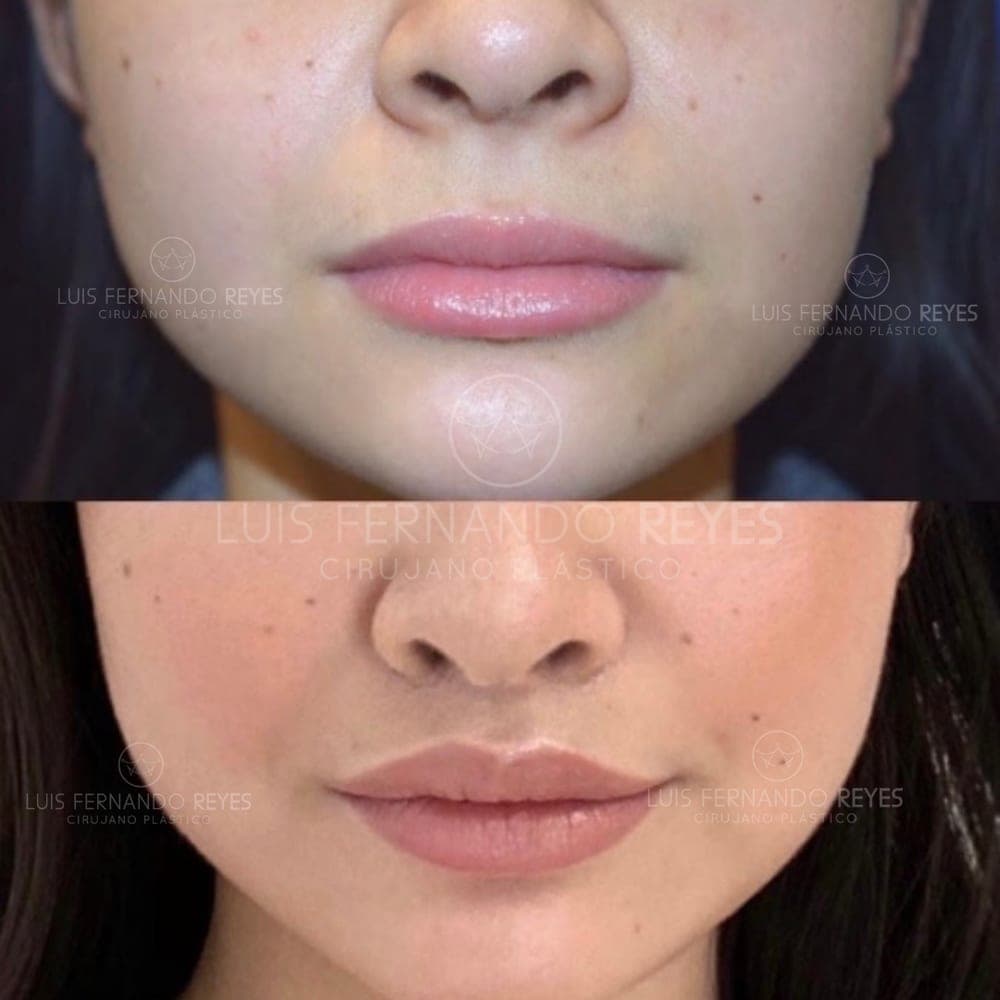Buccal fat removal before and after — before above, after below