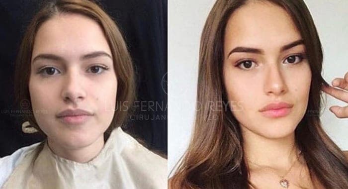 Buccal fat removal before and after — before left, after right