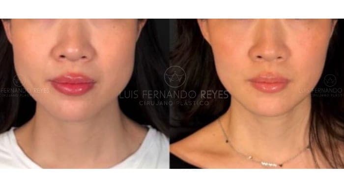 Buccal fat removal before and after — before left, after right
