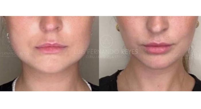 Buccal fat removal before and after — before left, after right